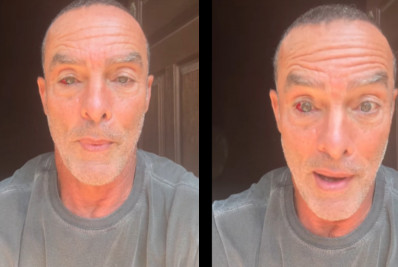  Paulo Zulu sofre derrame no olho em incidente com o filho: 'Ele ficou mal'