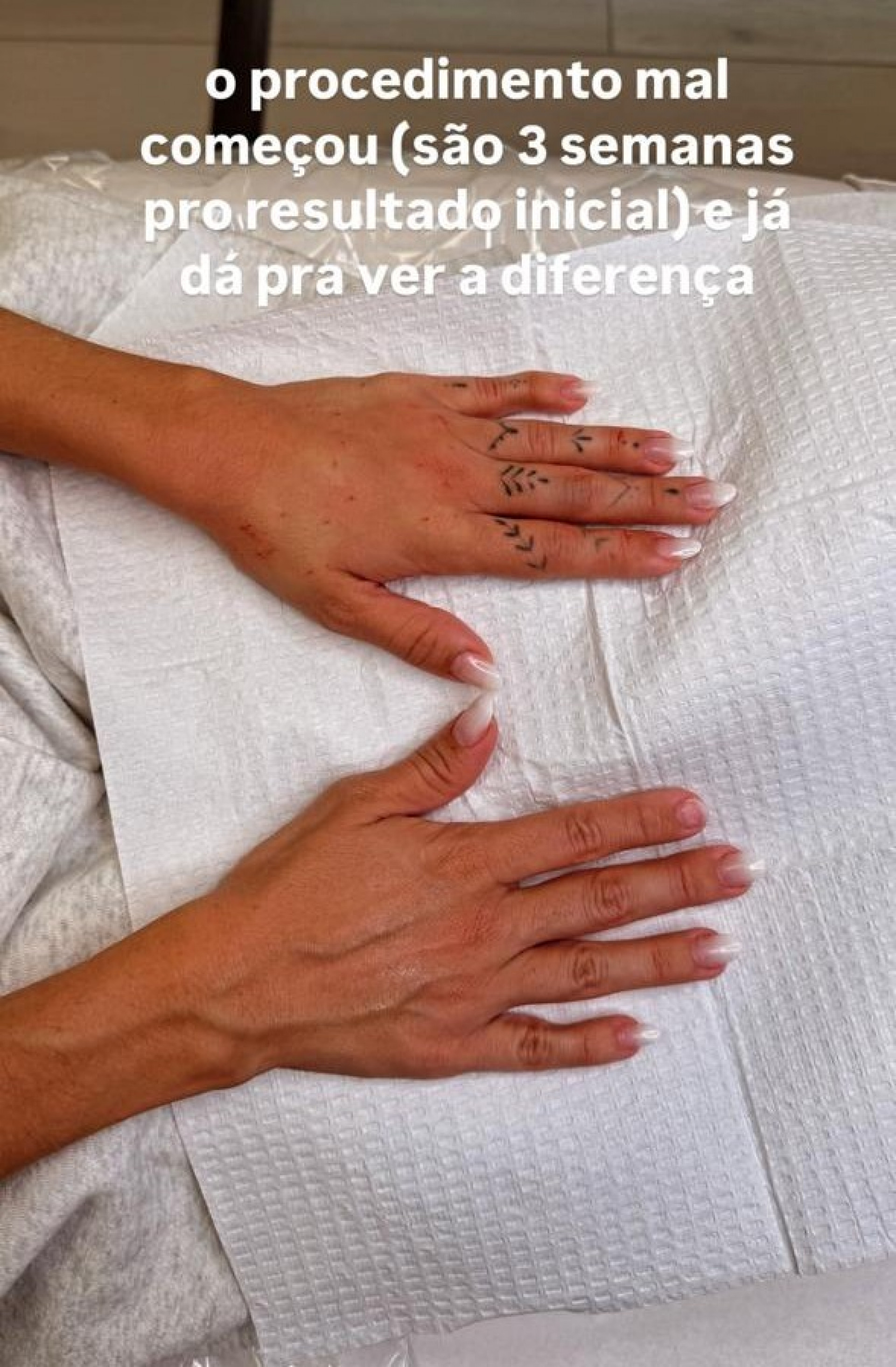 Gkay realiza harmonização das mãos com dermatologista das Kardashians em LA - Reprodução / Instagram 