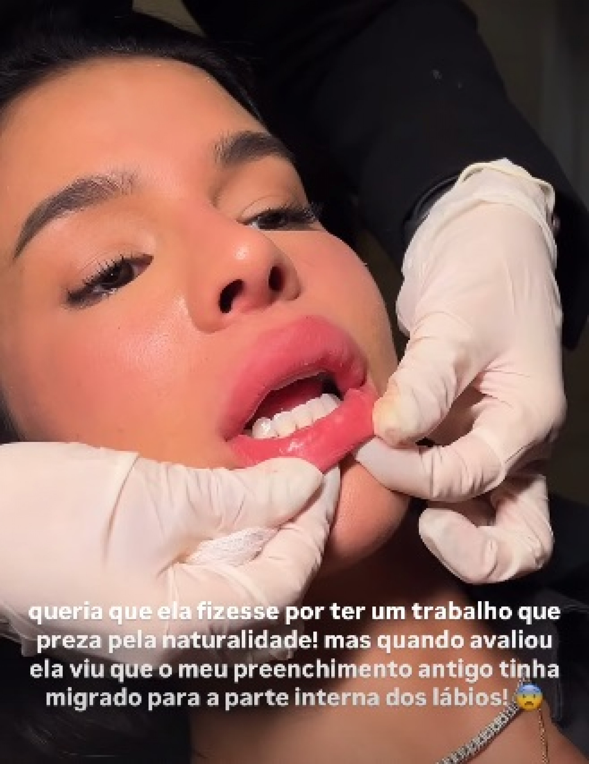 Ex-BBB Kerline retirou preenchimento labial - Reprodução/Instagram