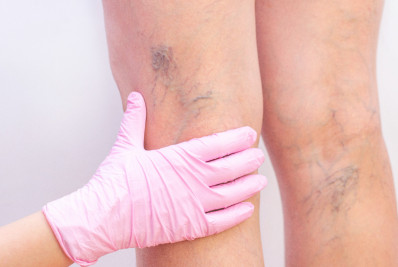 Problemas com a saúde vascular? médico explica os principais sintomas