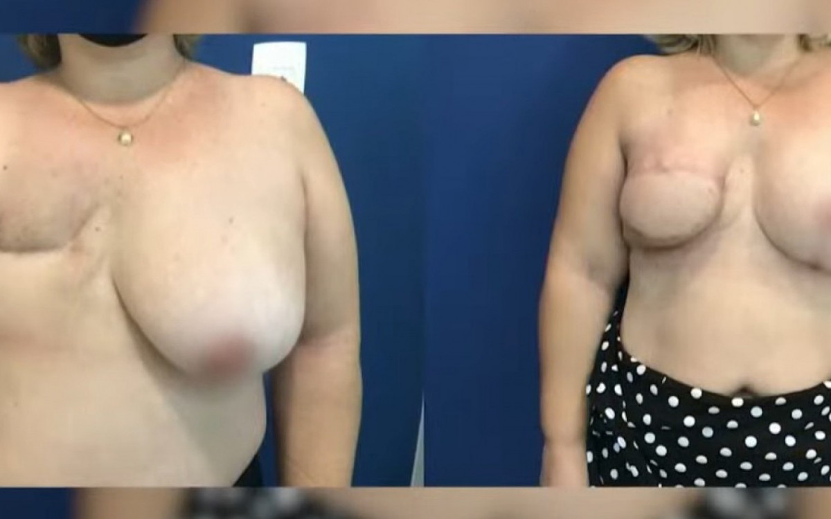 Diversos hospitais credenciados oferecem cirurgia de reconstrução mamária