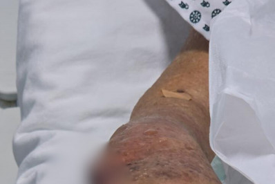 Idosa tem dedo e parte da mão amputados depois de ataque de pitbull