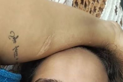 Cachorro que arrancou lábio de tutora é submetido a eutanásia em Rondônia