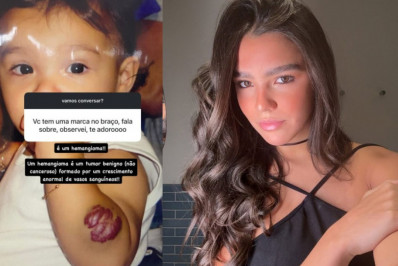 Duda Guerra explica marca no braço: 'Tumor benigno '