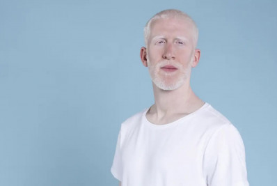 Lei que cria política de proteção a pessoas com albinismo é sancionada