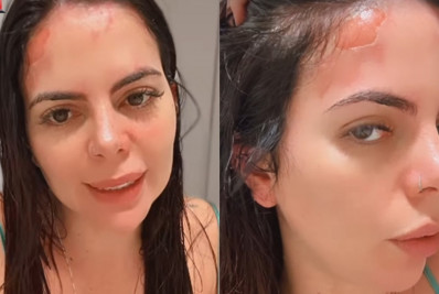 Panela de pressão explode e ex-Casamento às Cegas sofre queimaduras