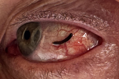 Homem descobre sanguessuga no olho após coceira constante; entenda