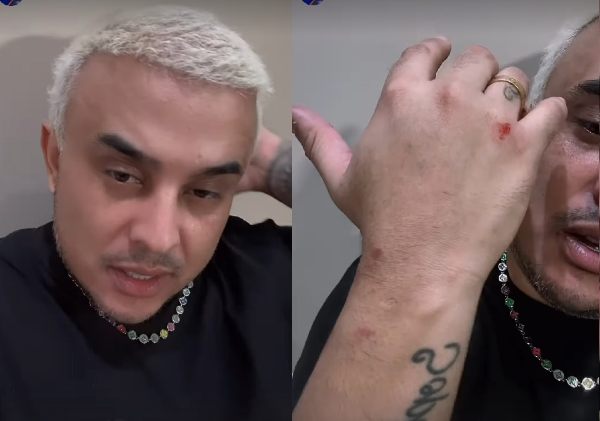 Kauan exibe machucados após tombo - Reprodução de vídeo