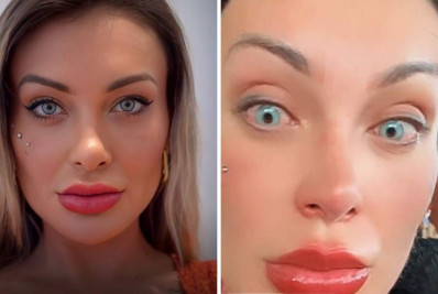Mudança na cor dos olhos: entenda os riscos de cirurgia feita por Andressa Urach