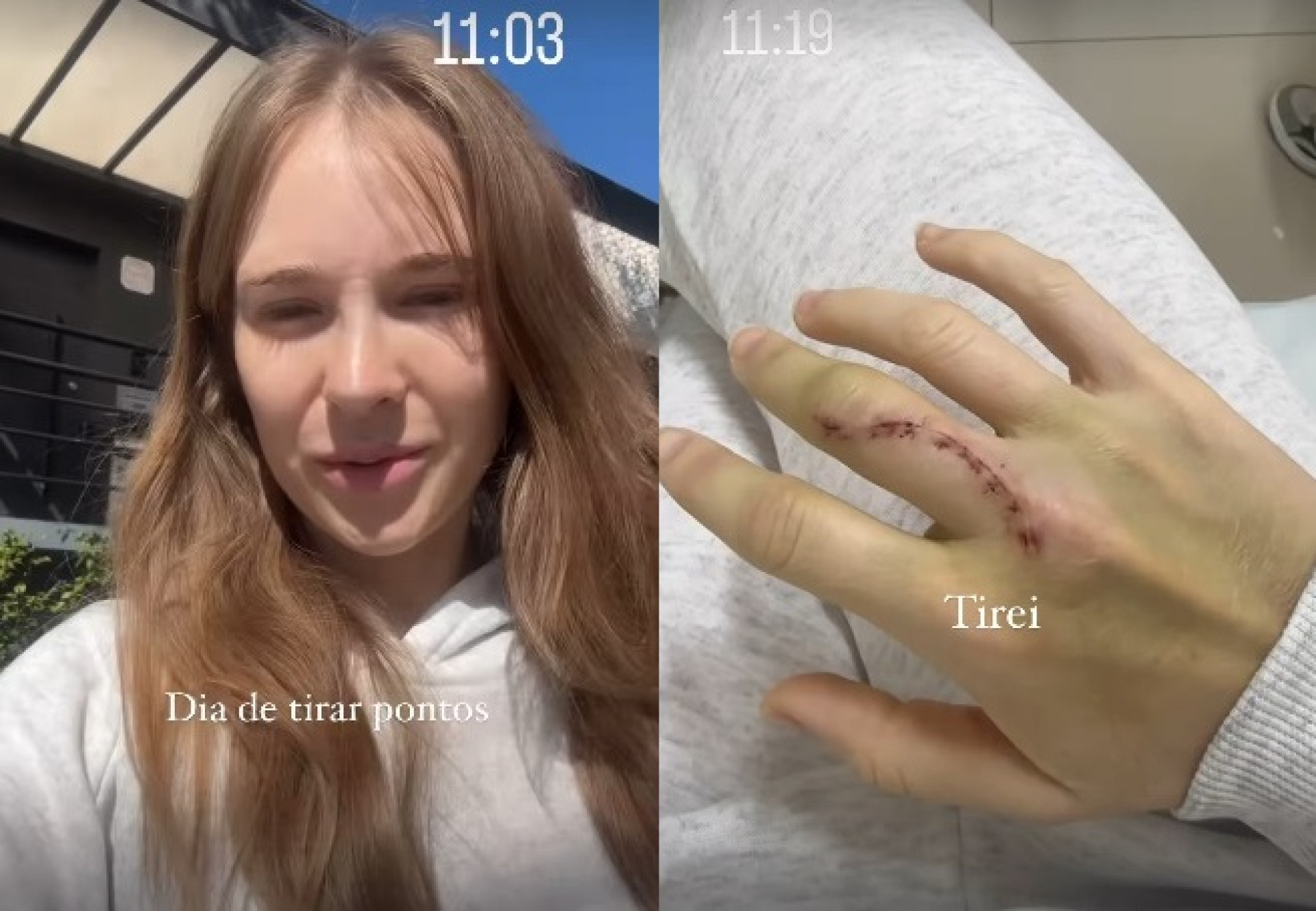 Sammy Sampaio retirou pontos da mão direita - Reprodução/Instagram