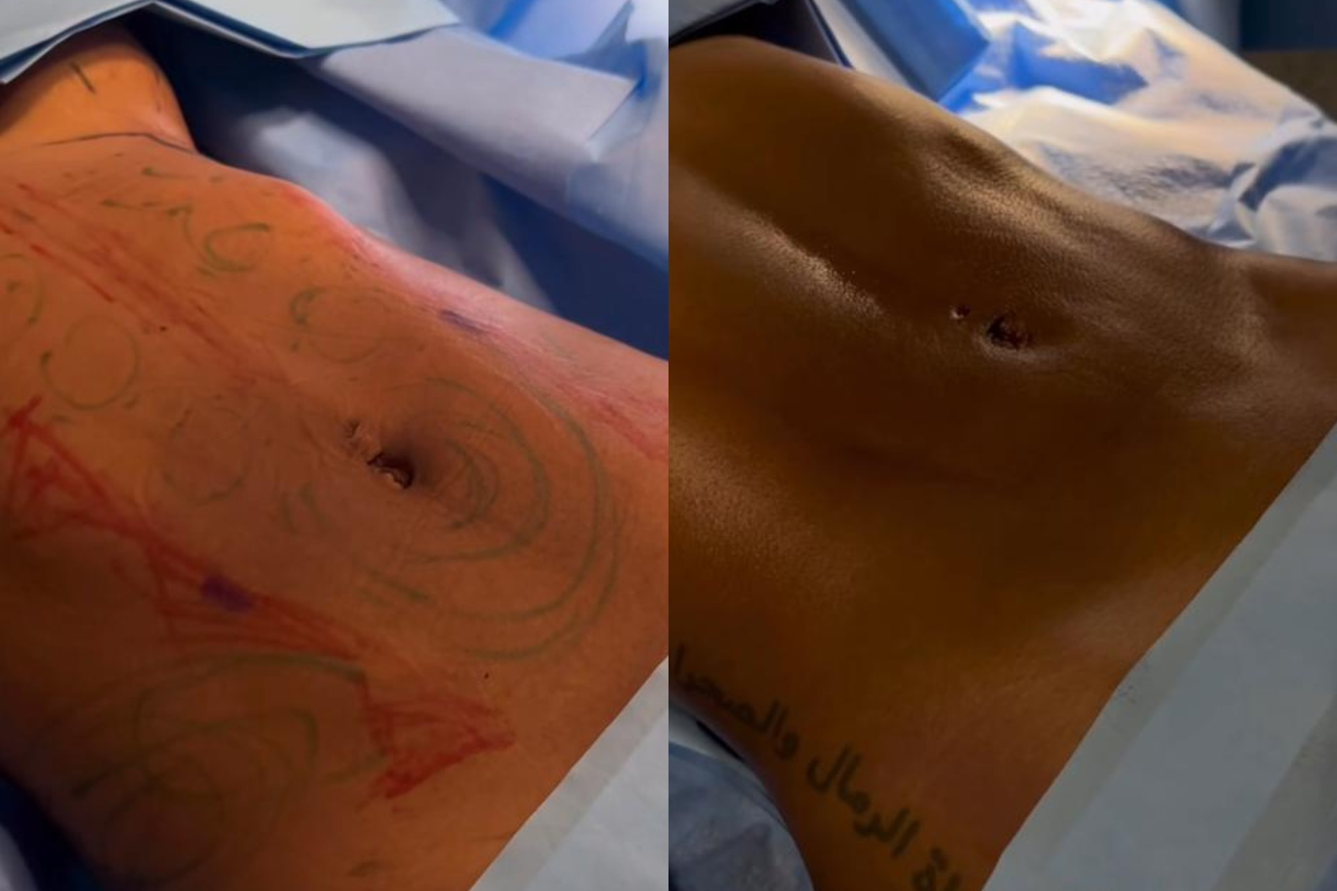 Lorena Maria exibe resultado das  cirurgias estéticas
 - Reprodução / Instagram