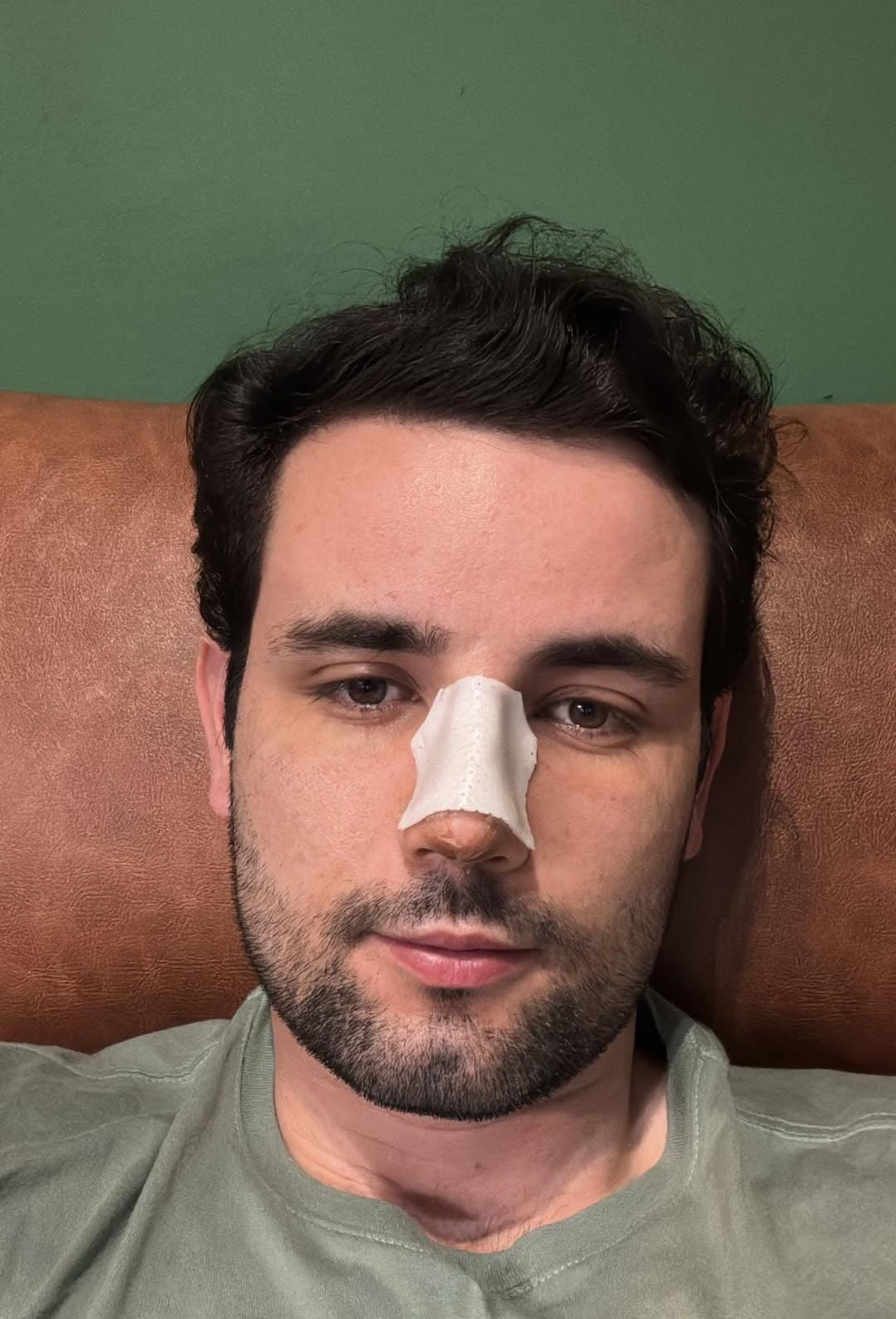 Ex-BBB Matteus Amaral faz cirurgia no nariz - Reprodução / Instagram