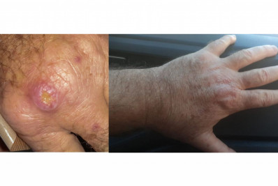 Especialistas alertam que cariocas desconhecem os riscos da leishmaniose