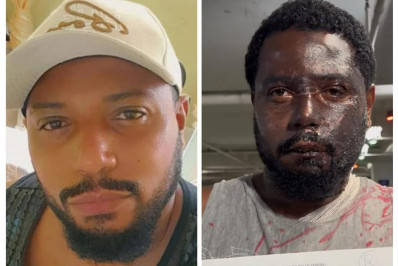 Homem denuncia que mulher queimou seu rosto e corpo com água quente em Magalhães Bastos