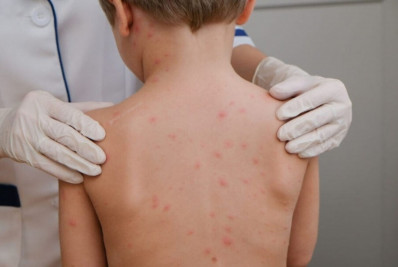 Baixada Santista registra ao menos 44 casos de meningite em 2025