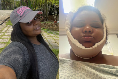 Após eliminar 70 kg, MC Carol faz lipo de papada e exibe antes e depois