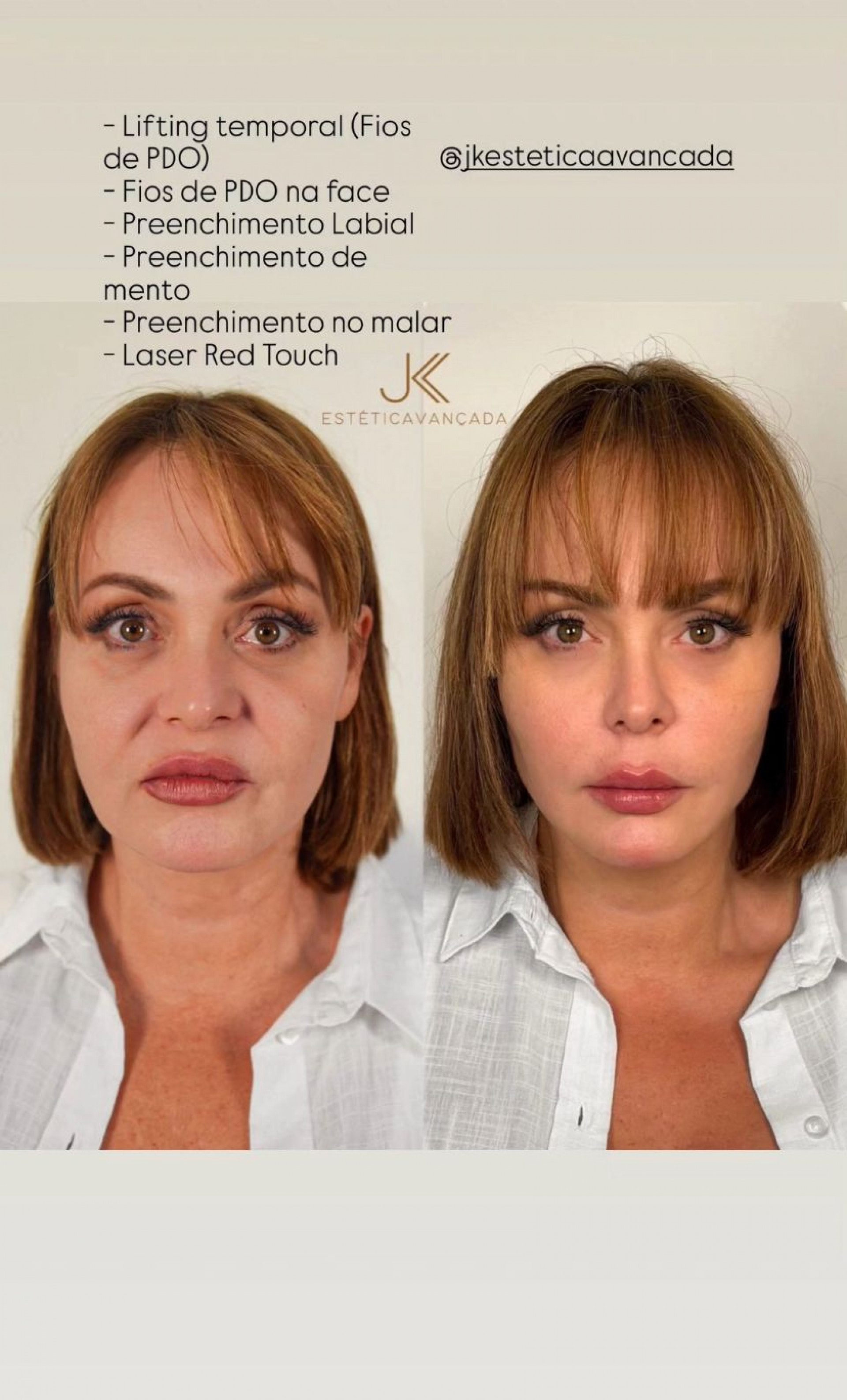 Gaby Spanic passa por harmonização facial e resultado impressiona fãs - Reprodução/Instagram
