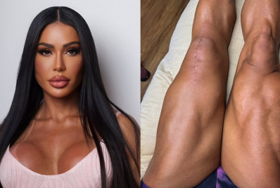 Gracyanne Barbosa mostra cicatriz de cirurgia no joelho: 'Parte de uma vitória'
