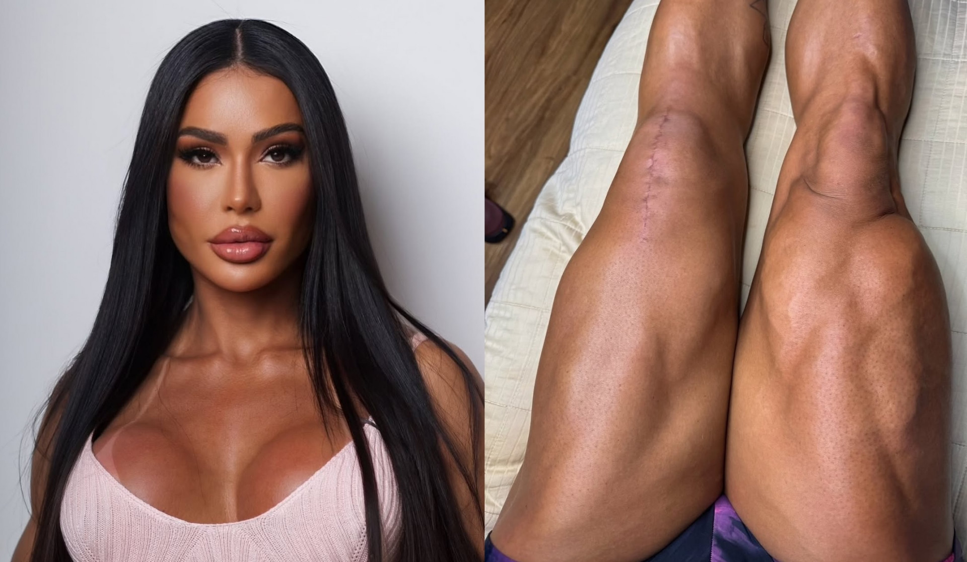 Gracyanne Barbosa exibiu cicatriz de cirurgia no joelho  - Reprodução/Instagram