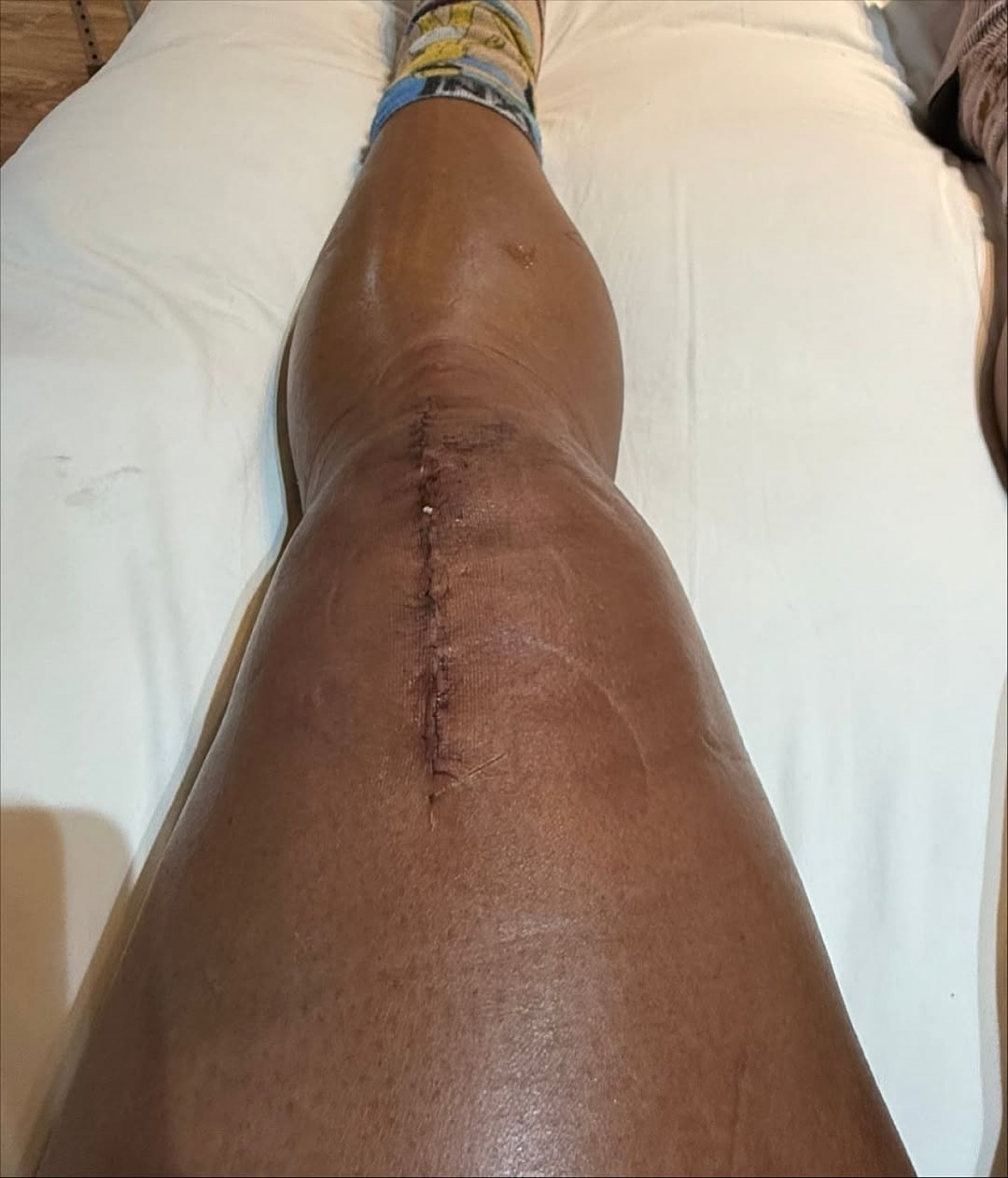 Gracyanne operou joelho após sofrer lesão no 'Dança dos Famosos' - Reprodução/Instagram