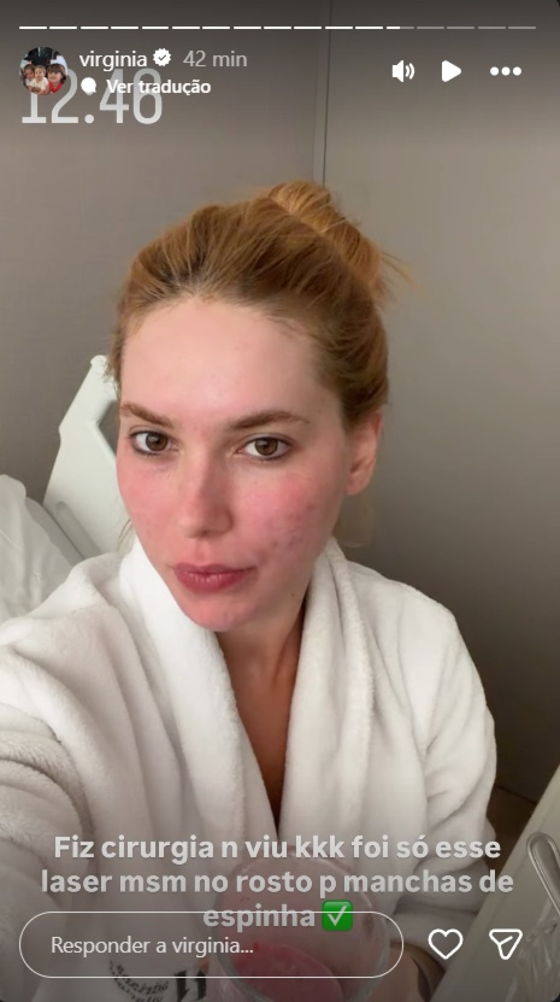 Virginia fala após procedimento para remoção de marcas de espinha - Reprodução / Instagram