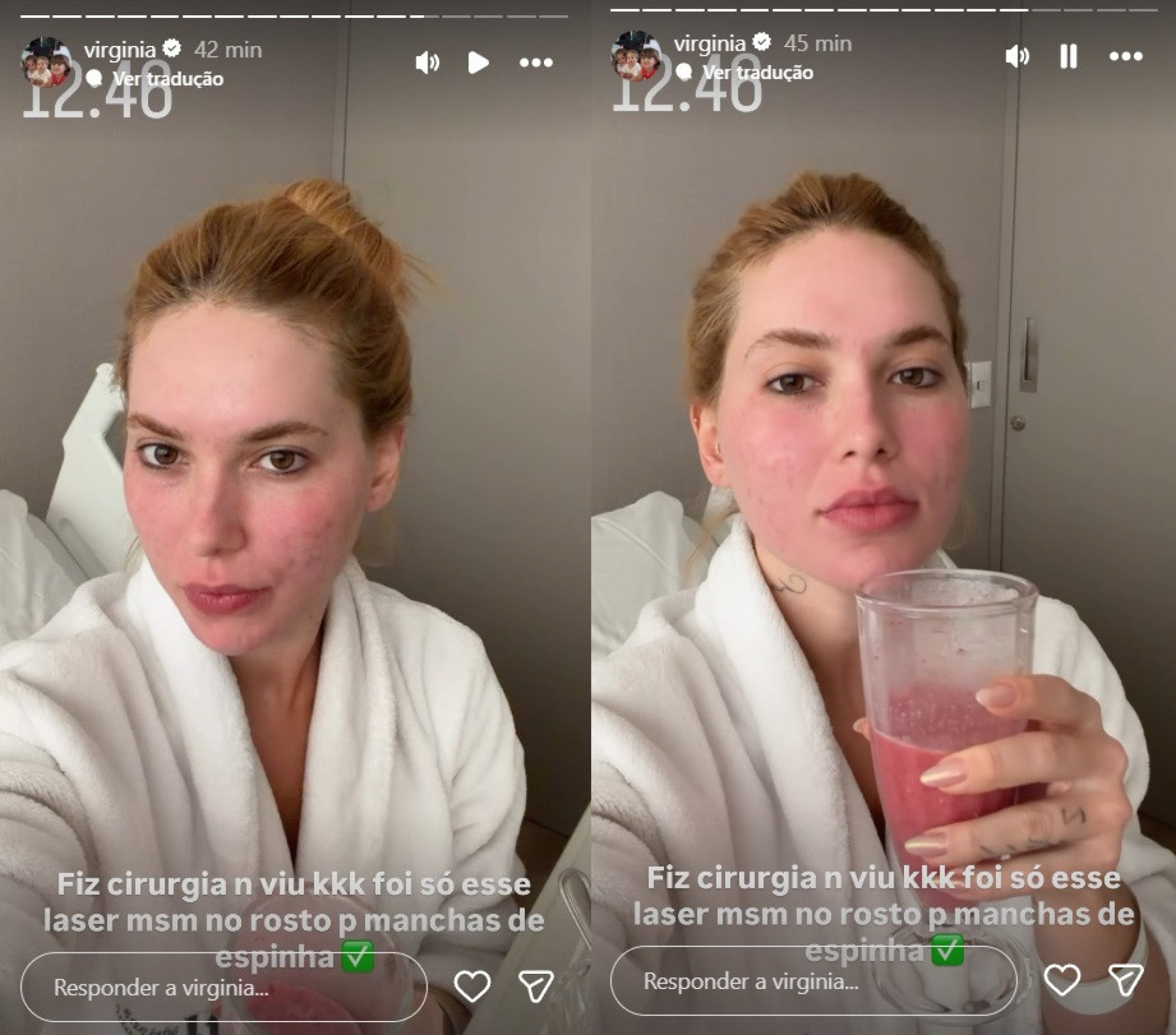 Virginia fala após procedimento para remoção de marcas de espinha - Reprodução / Instagram