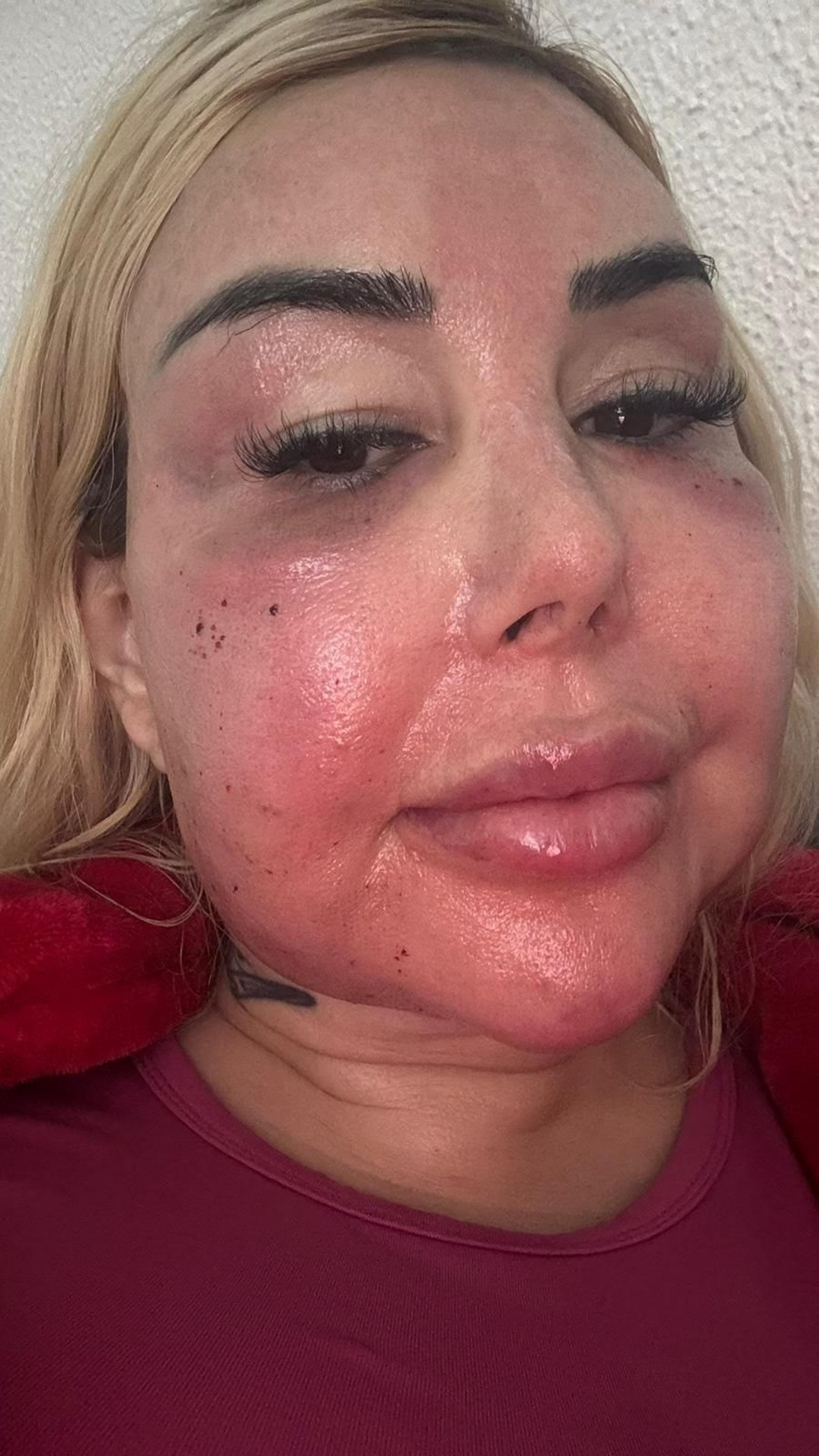 Patrícia Ribeiro se recupera de nova cirurgia para retirada de silicone industrial e compara caso ao de Juju do Pix