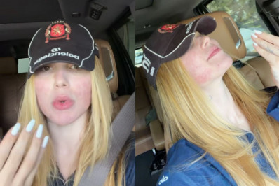 Após reação intensa, Virginia desabafa sobre procedimento estético no rosto 