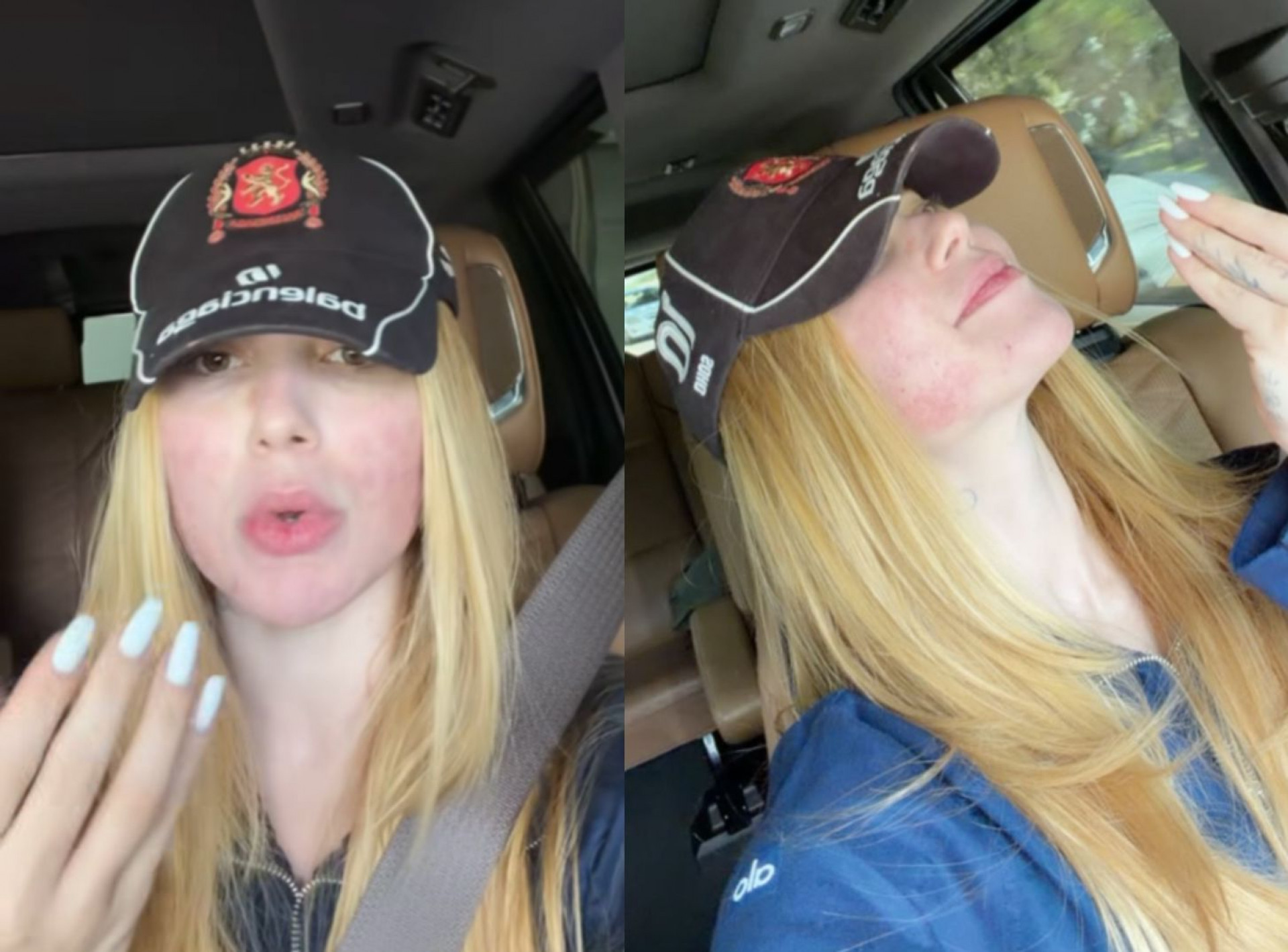 Virginia lamenta resultado após procedimento estético no rosto - Reprodução/Instagram