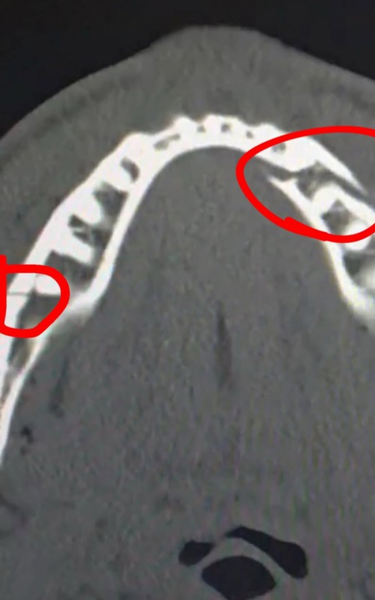 Jake Paul compartilhou imagem do raio-x de sua mand&iacute;bula com duas fraturas  - Reprodu&ccedil;&atilde;o de Instagram