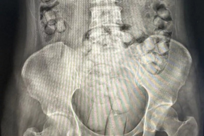Mulheres são presas em aeroporto com mais de 100 cápsulas de drogas no ânus