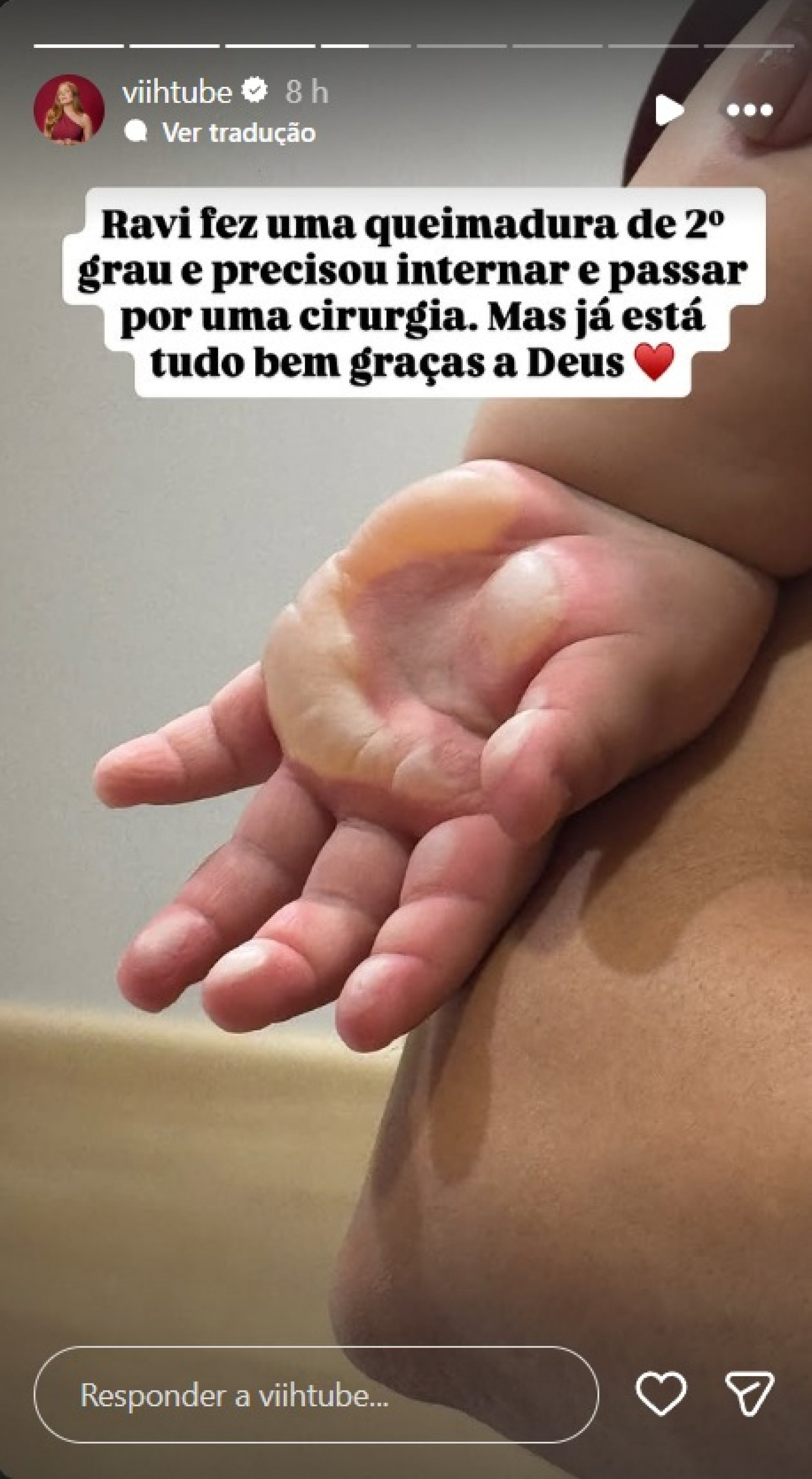 Como ficou a mão de Ravi após se queimar - Reprodução / Instagram