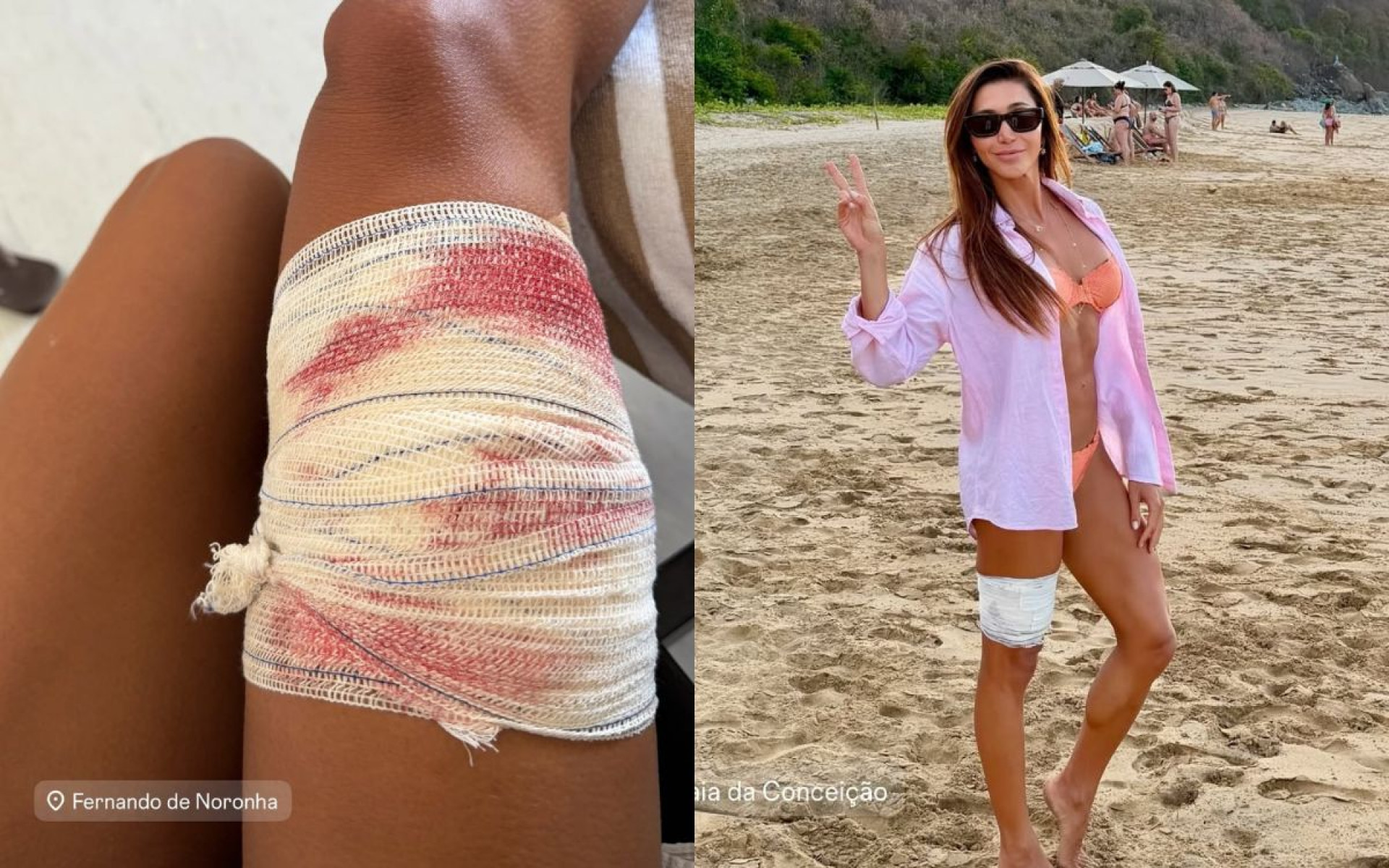 Turista paulista foi mordida por um tubarão em Fernando de Noronha - Reprodução / Instagram