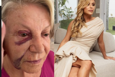 Aos 84 anos, mãe de Poliana Rocha sofre acidente e fica com hematoma no rosto