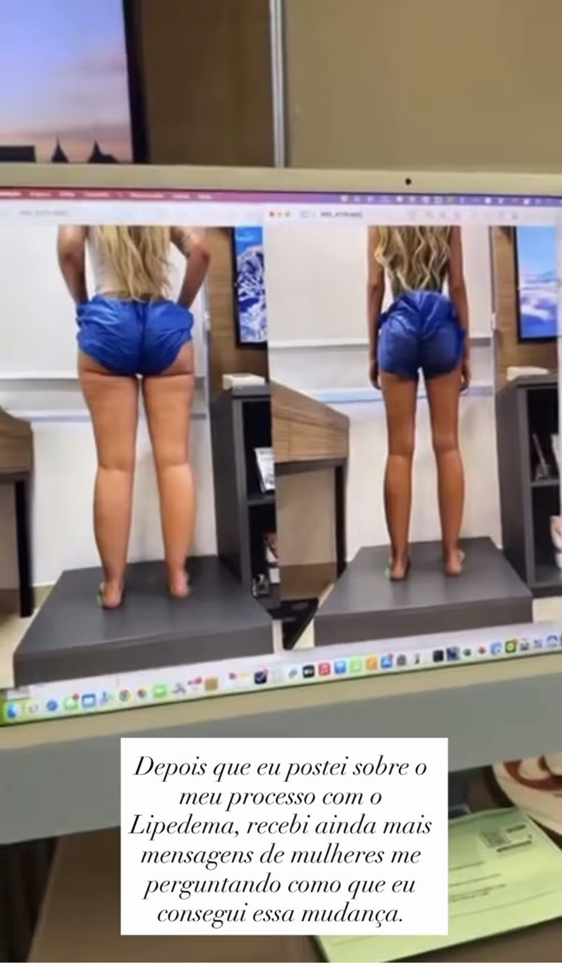 Yasmin Brunet mostra antes e depois após perder 15 kg com tratamento para lipedema - Reprodução / Instagram