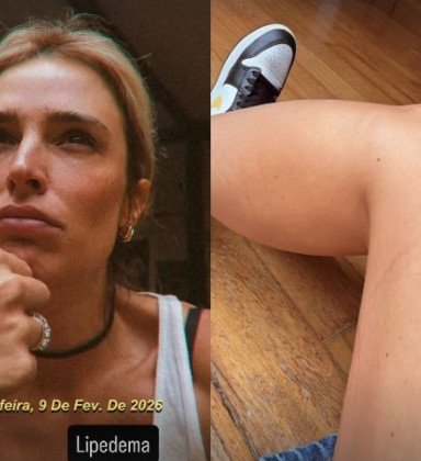 Rafa Brites revela diagnóstico de lipedema: 'Sinto muita dor'