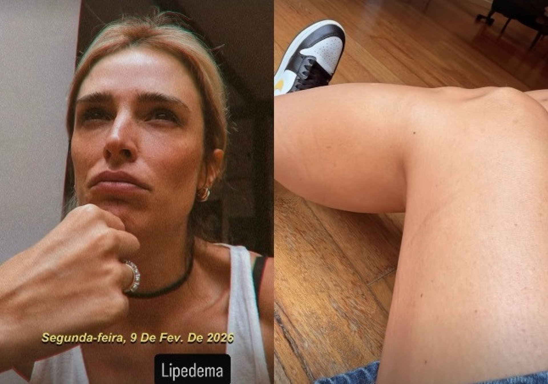 Rafa Brites foi diagnosticada com lipedema  - Reprodução/Instagram 