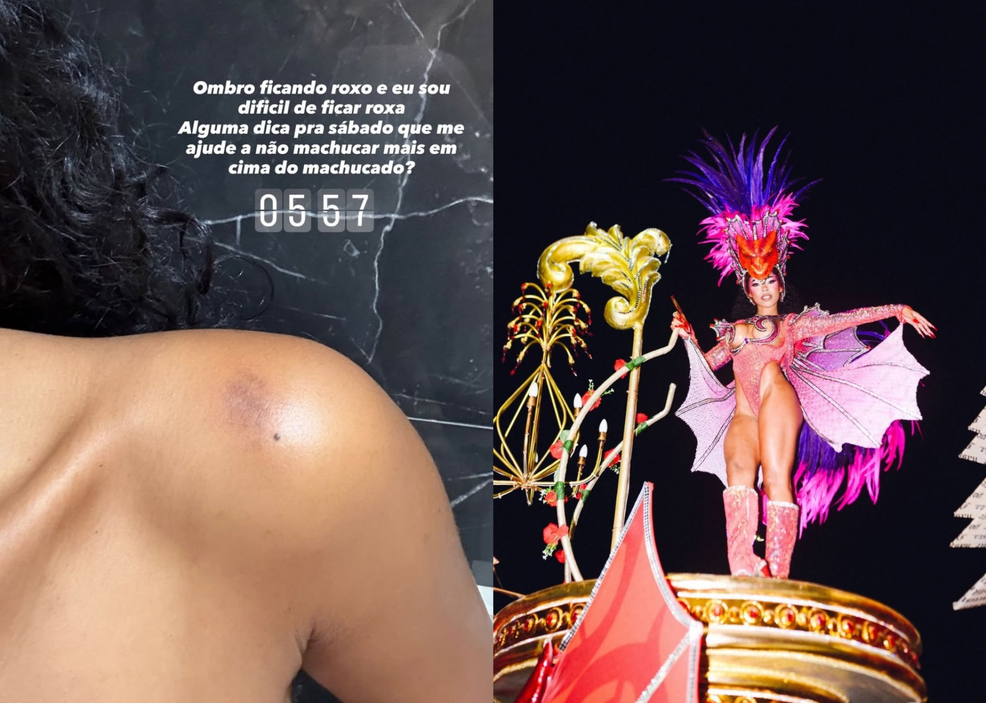 Lorena Maria exibiu hematomas após desfile do Salgueiro - Reprodução/Instagram