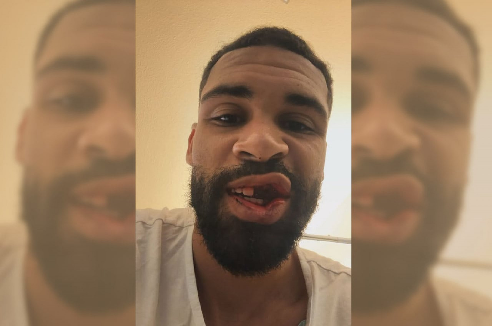 Jogador do Milan aparece sem dentes ap&oacute;s fraturar mand&iacute;bula