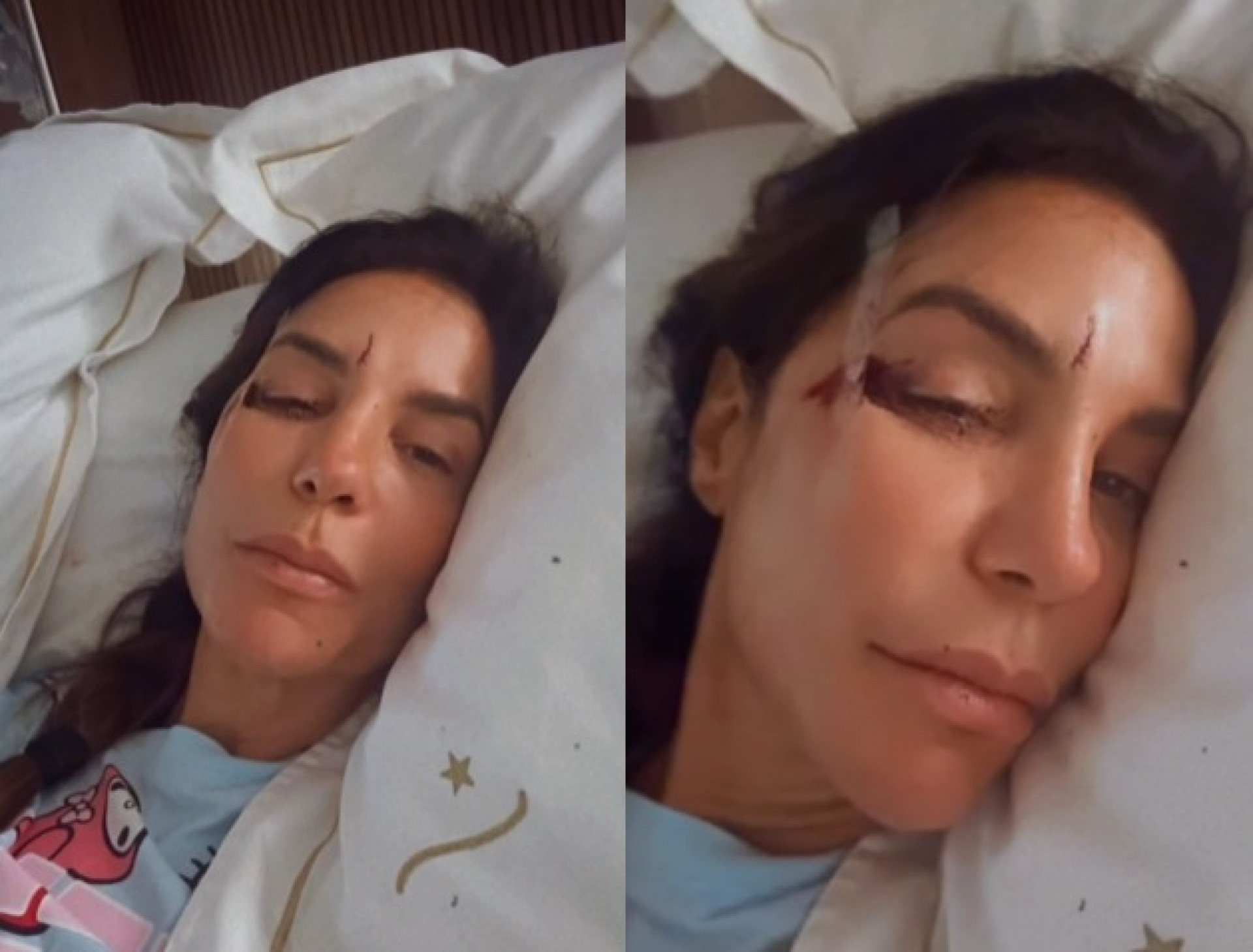 Ivete Sangalo mostrou ferimentos no rosto durante internação  - Reprodução/Instagram 