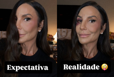 Ivete Sangalo mostra rosto após queda: 'Realidade'