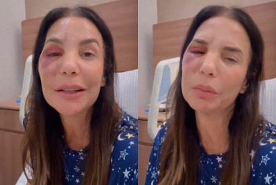 No hospital, Ivete Sangalo revela que quebrou dois ossos do rosto e precisou de cirurgia