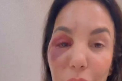 Ivete Sangalo recebe alta depois de cirurgia no rosto: 'Estou ótima'