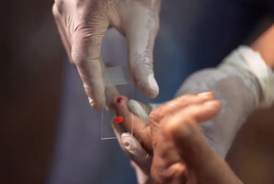 SUS começa a usar novo tratamento contra a malária em crianças