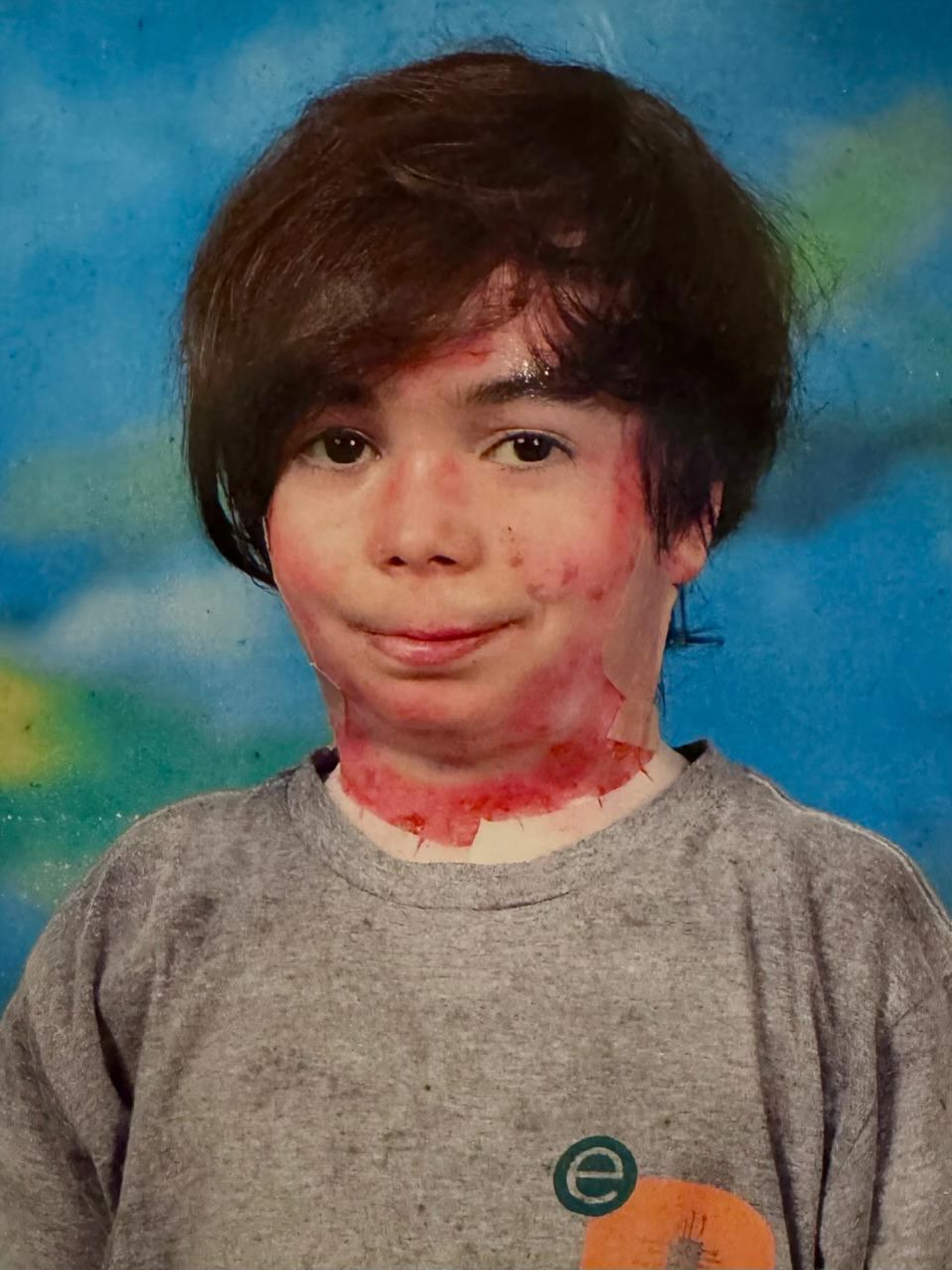 Theo, neto de Deborah Colker, morre aos 14 anos de epidermólise bolhosa