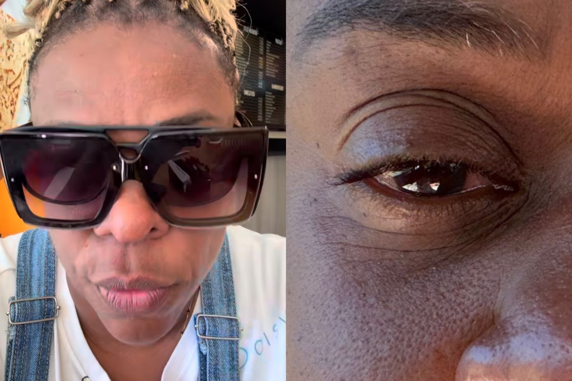 Cacau Protásio tem reação alérgica grave a pomada capilar: 'Dor desesperadora'