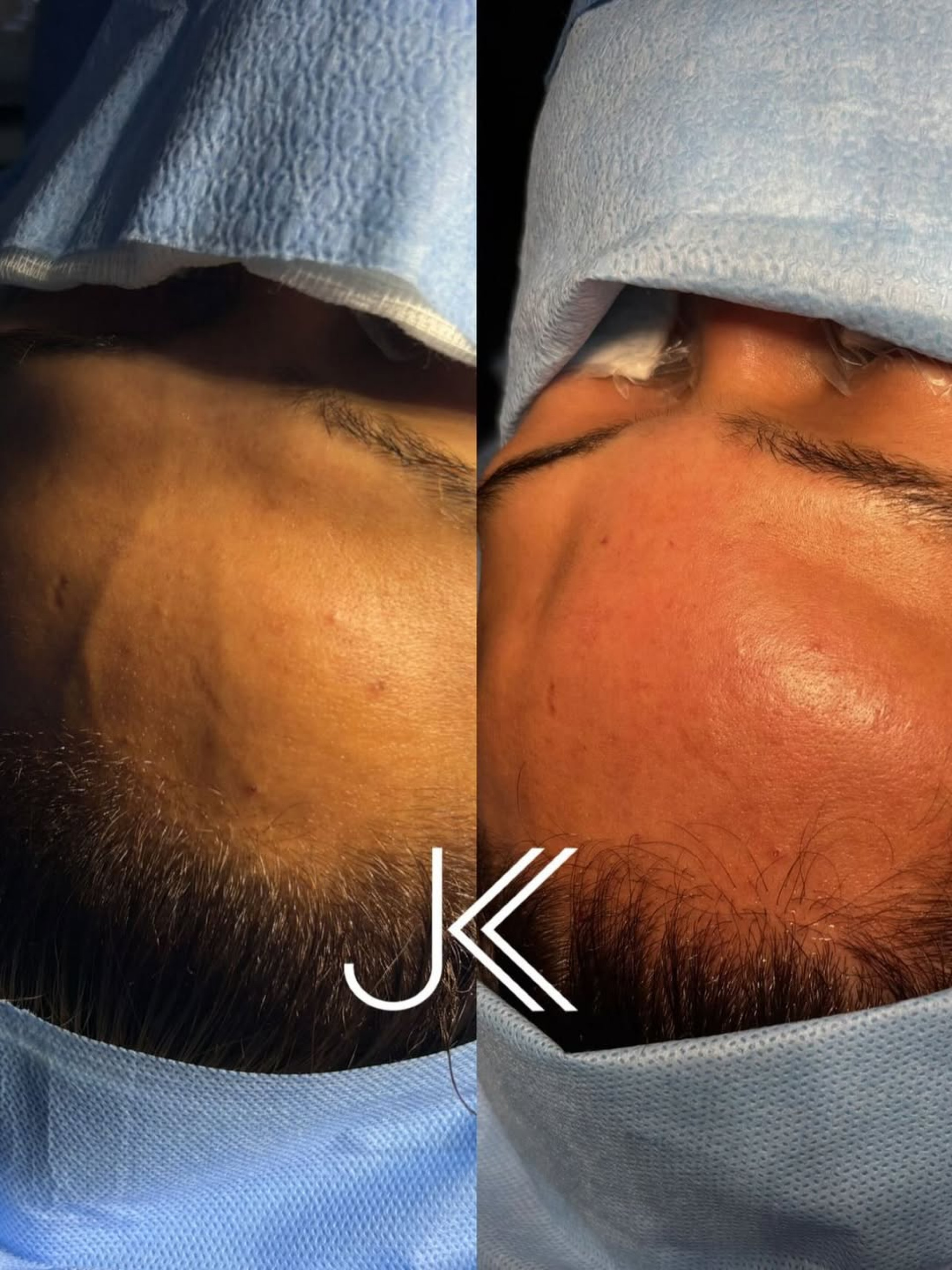 Camila Loures mostra antes e depois de procedimento na testa - Reprodução / Instagram