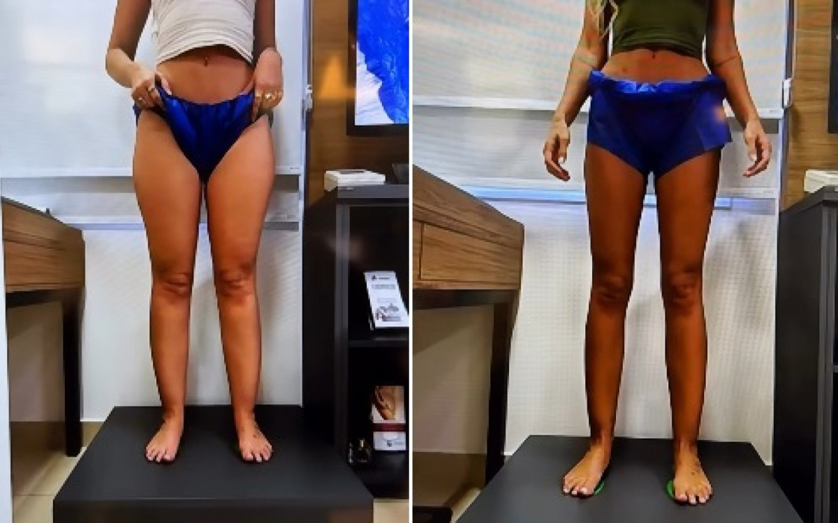 Yasmin Brunet mostra antes e depois ap&oacute;s perder 25 kg - Reprodu&ccedil;&atilde;o Instagram