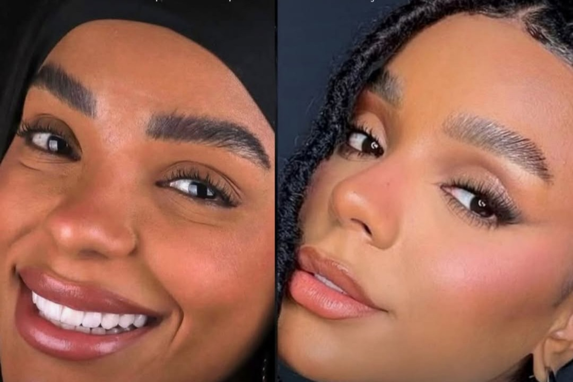 Brunna Gonçalves exibe antes e depois ao remover micropigmentação - Bruna Zanatta / Instagram