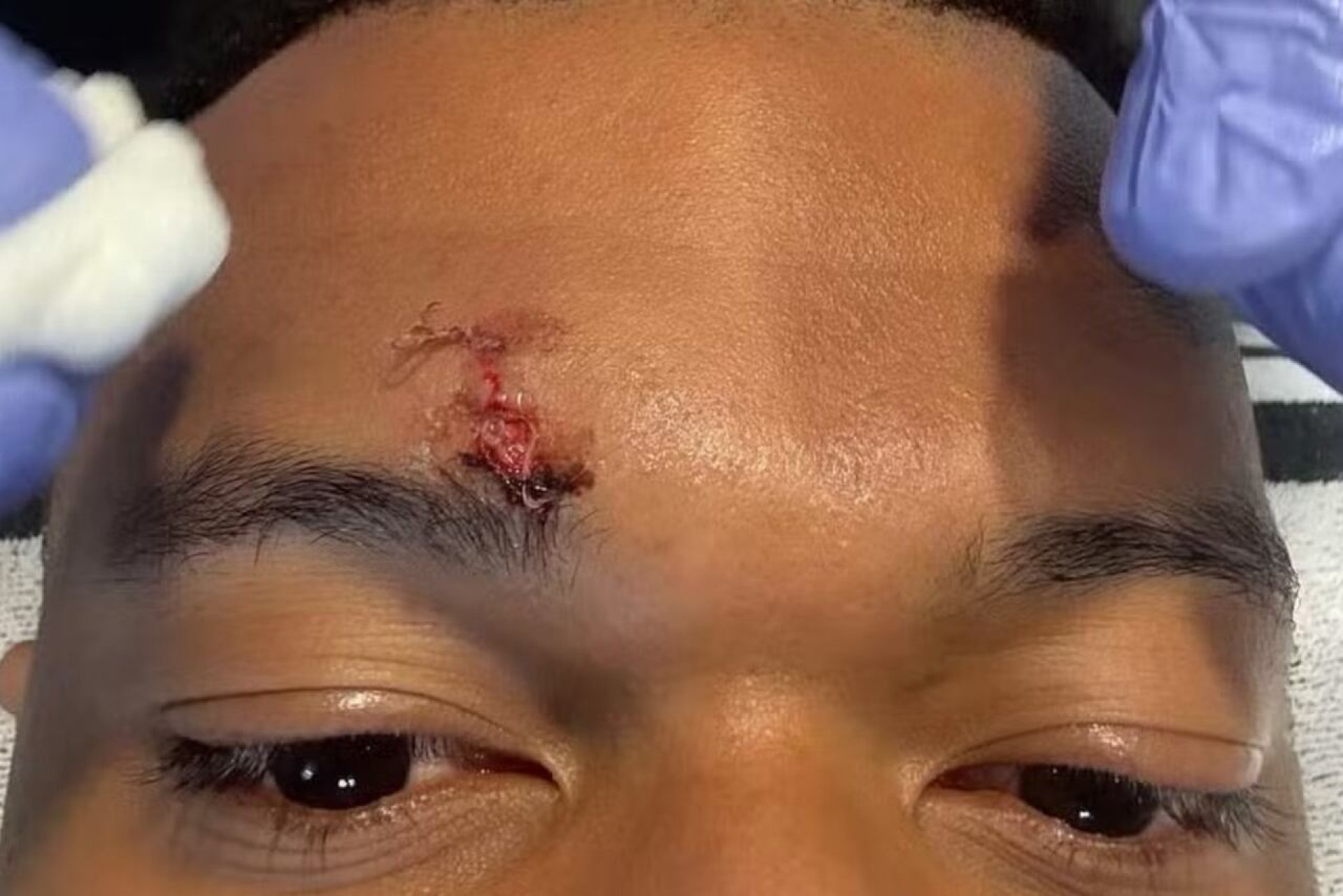 Mbapp&eacute; leva pontos no rosto e vira d&uacute;vida para treino do Real Madrid